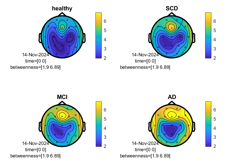 New study reveals subtle brain network changes in early Alzheimer’s